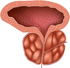 Уголемена простата